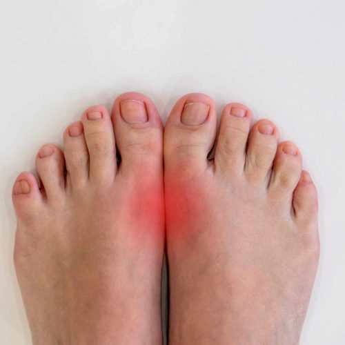 how do i know if my toe is broken or just bruised