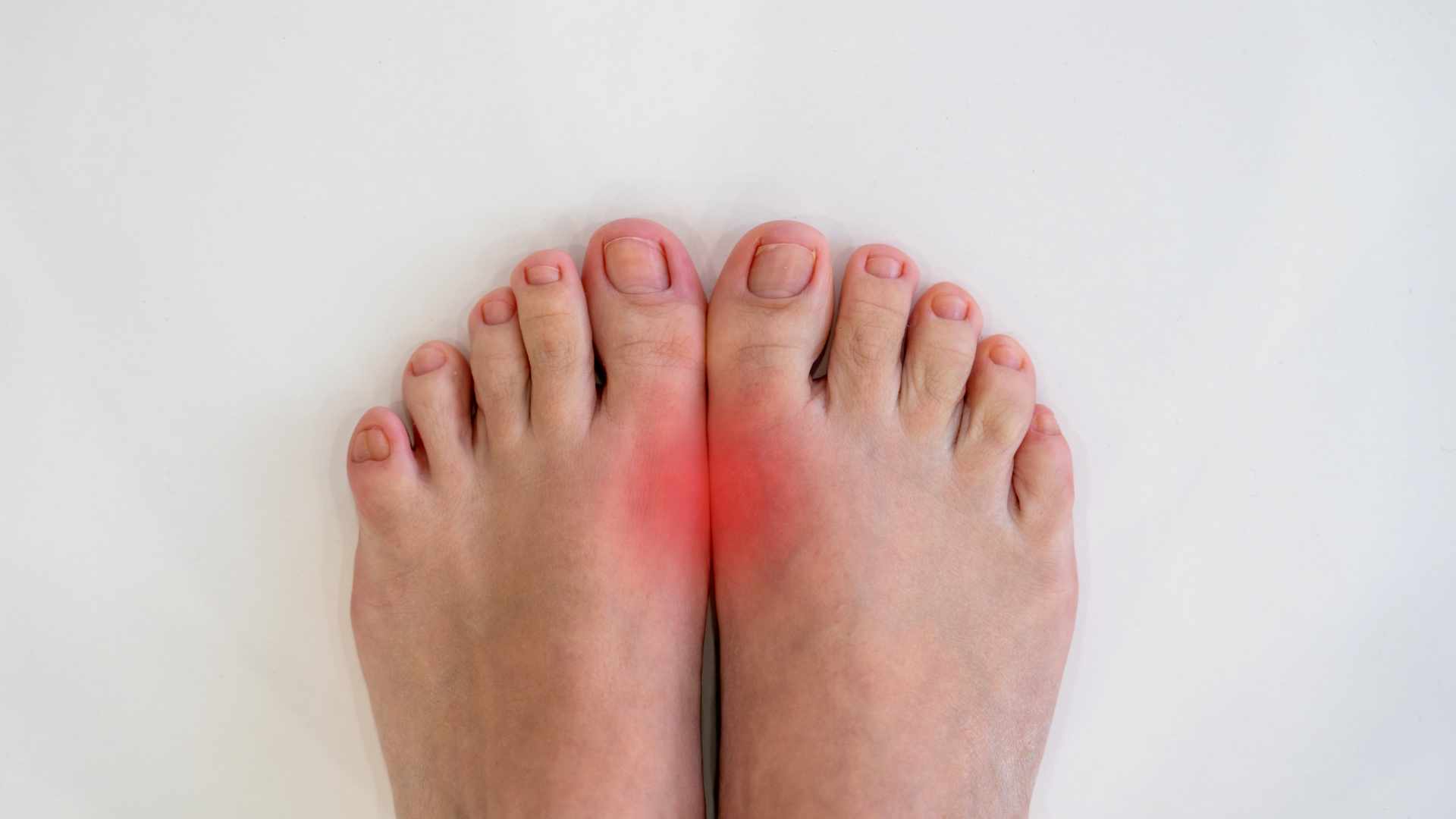 how do i know if my toe is broken or just bruised