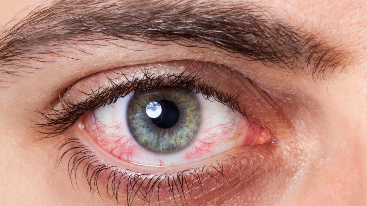 Why Did I Wake Up With a Red Spot in My Eye