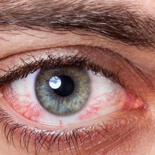 Why Did I Wake Up With a Red Spot in My Eye